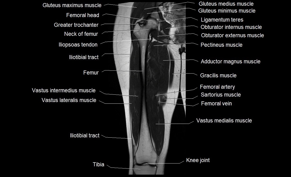 MRI thigh coronal cross sectional anatomy image 12.webp